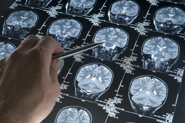 Alzheimer'da gençlik proteini keşfi